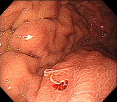 胃アニサキス症の内視鏡画像