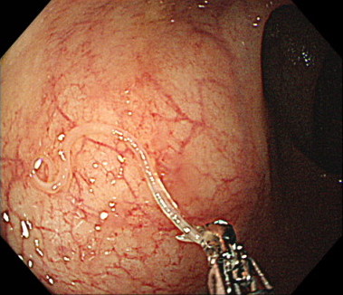 直腸アニサキス症の内視鏡画像