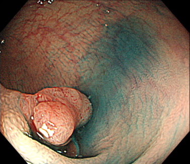 早期⼤腸がんの内視鏡画像