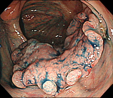 進⾏⼤腸がんの内視鏡画像