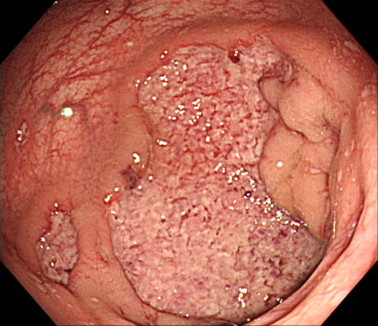 こちらは、不整形で大きな潰瘍がみられます。