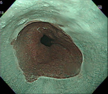 胃・食道接合部の内視鏡画