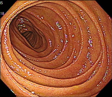 十二指腸（下行脚）の内視鏡画像