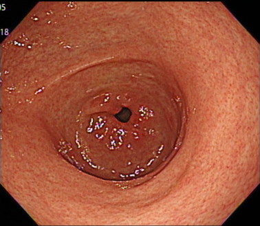 胃の出口（幽門部・前提部）の内視鏡画像