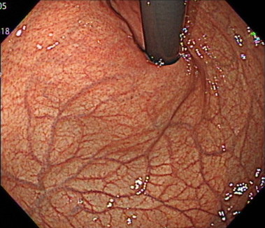 胃の穹窿部（きゅうりゅうぶ）の内視鏡画像