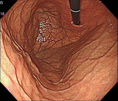 胃の体中部〜体上部大弯の内視鏡画
