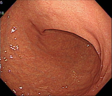胃の体下部〜体中部大弯（見下ろし）の内視鏡画像