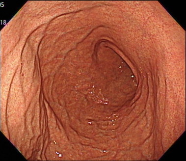 胃の体中部〜体上部大弯（見下ろし）の内視鏡画像
