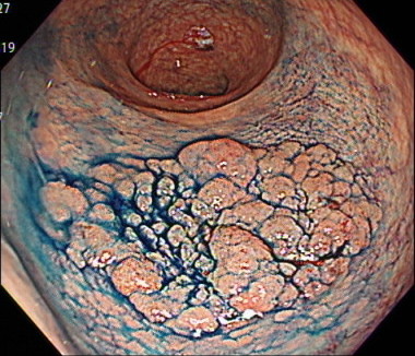 側方発育型腫瘍（LST）の内視鏡画像