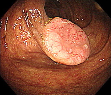 陥凹型腫瘍（がん）の内視鏡画像