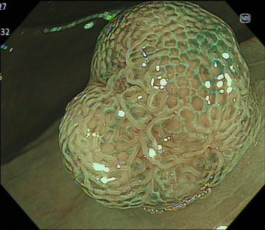 大腸腺腫の内視鏡画像（NBI）