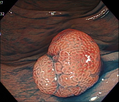 大腸腺腫の内視鏡画像（色素散布）