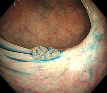 絨毛腺腫の内視鏡画像（色素散布）