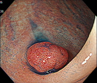 内視鏡的粘膜切除術（EMR）の内視鏡画像