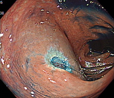 内視鏡的粘膜切除術（EMR）の内視鏡画像