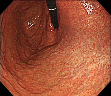 ピロリ菌のいる胃の内視鏡画像