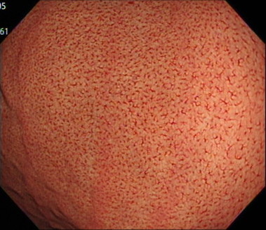 ピロリ菌のいる胃の内視鏡画像