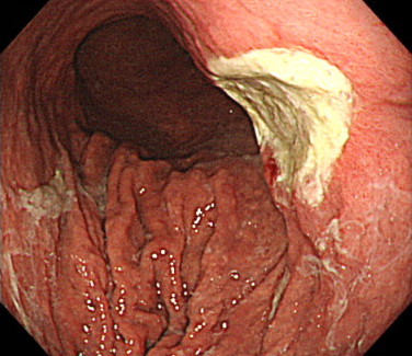 胃潰瘍・⼗⼆指腸潰瘍