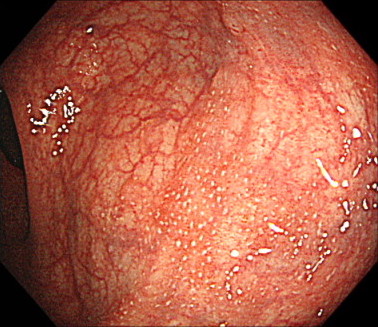 軽症の潰瘍性大腸炎の内視鏡画像