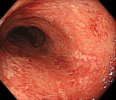 中等症の潰瘍性大腸炎の内視鏡画像
