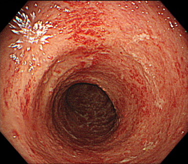 こちらも中等症の潰瘍性大腸炎の内視鏡画像です。