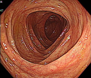 ※正常の大腸の内視鏡画像