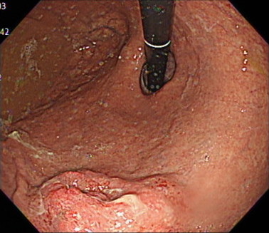 胃がんの内視鏡画像