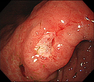 胃潰瘍（良性潰瘍）の内視鏡画像