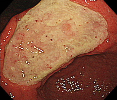 胃潰瘍の内視鏡画像（NSAIDs潰瘍）