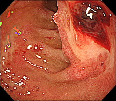 ⼗⼆指腸潰瘍の内視鏡画像