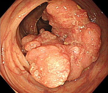 大腸がんの内視鏡画像