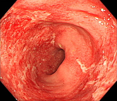 抗⽣物質による出⾎性⼤腸炎の内視鏡画像